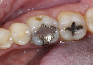 Obturação no dente: é feio e faz mal para sua saúde!