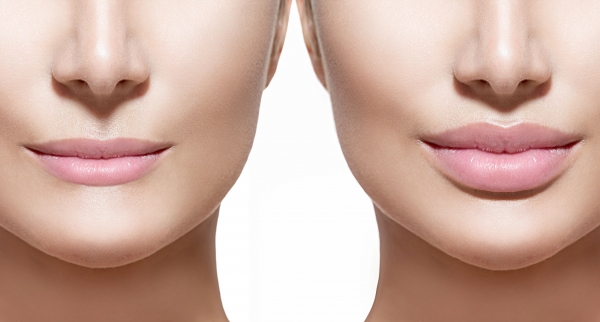 Qual é o melhor procedimento para preenchimento dos lábios?