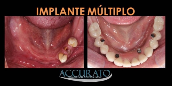 Implante de Vários Dentes: Dentadura Fixa